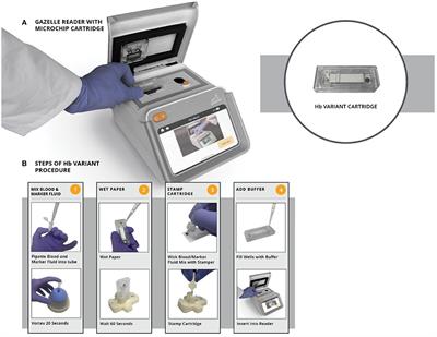Evaluation of Microchip-Based Point-Of-Care Device “Gazelle” for Diagnosis of Sickle Cell Disease in India